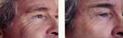 Plasma skin regeneration eyes side before and after photo