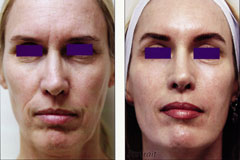 Plasma skin regeneration face before and after photo