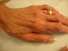 Restylane hands after photo