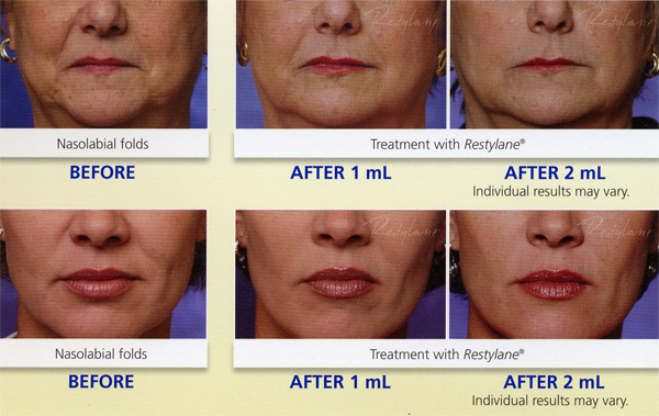 Restylane treatment photo