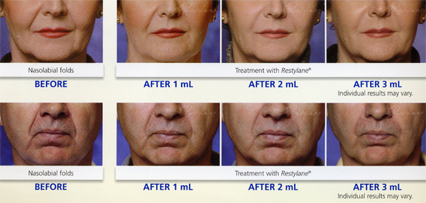 Restylane treatment photo