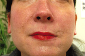Restylane silk after photo