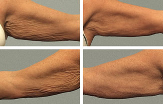 Thermage arm before and after photo