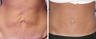 Thermage stomach before and after photo